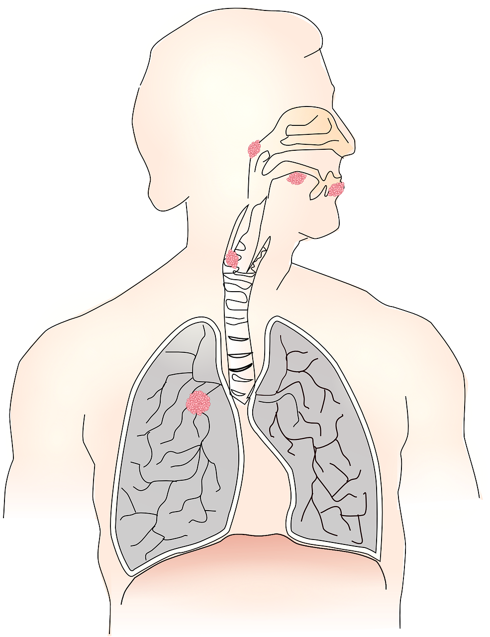 Cancer du poumon : entre mutations et traitements innovants ...